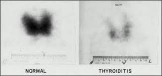 Hashimoto S Thyroiditis Endotext Ncbi Bookshelf