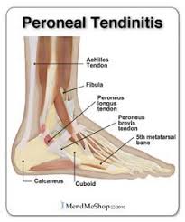 Symptoms Treatments Of Foot Tendonitis Peroneal Tendonitis Tendonitis Foot Tendinitis