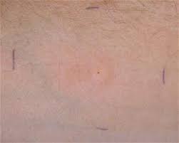 In the following test, we ask for symptoms that may occur in ppd. Tb Skin Testing