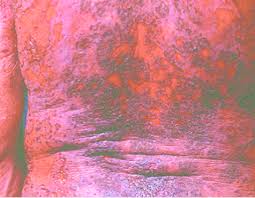 Baixe fotos de fogo selvagem no enorme banco de imagens milhões de fotos imagens, ilustrações livres de royalties de alta qualidade a preços acessíveis. Fogo Selvagem Forma Generalizada Eritrodermica Download Scientific Diagram