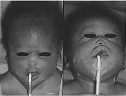 Airway Management in an Infant with Alobar Holoprosencephaly and  Cebocephaly Associated with Maternal Diabetes Mellitus