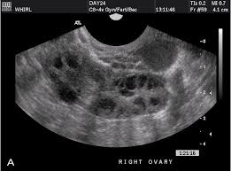 Patients with polycystic ovarian syndrome often have painful periods, dr. Transvaginal Ultrasonography And Female Infertility Glowm