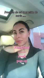 1 semana post-Op de mi Rinoplastia….. Con el Dr. Angel Elias Cd Juarez...