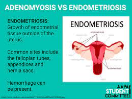 Adenomyosis is similar to endometriosis in some ways, but adenomyosis has different causes, and behaves differently. Endometriosis And Adenomyosis Are Aapa Student Committee Facebook