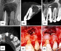 FR : Comparaison radiographie conventionnelle vs CBCT lésion parodontale
