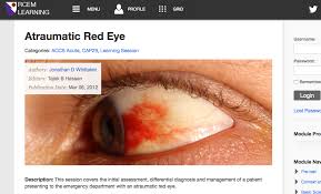 Image result for Acute Red Eye