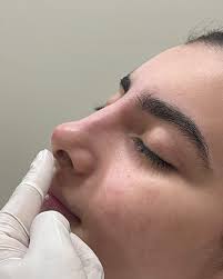 Nariz mais harmônico sem cirurgia é mais fácil do que você imagina! ✨💉 O  preenchimento nasal corrige assimetrias, eleva a ponta e melhora o contorno  com naturalidade e sem tempo de recuperação.