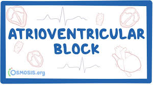 Image result for Atrioventricular Block