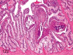And national board of medical examiners® (nbme®). Seminal Vesicle Spermatocele Focal Accumulation Of Spermatozoa Download Scientific Diagram