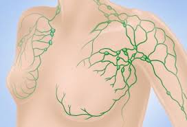 Irritation or dimpling of breast skin. Where Breast Cancer Spreads Lymph Nodes Bones Liver Lungs Brain