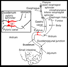 Pyloric Stenosis As Cause Of A Venous Hypertensive Syndrome