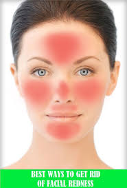 Some Tips To Get Rid Of Redness On Face Redness On Face Red Face Remedies Face Mask For Redness