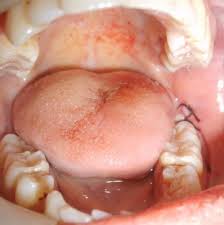 Image result for Alveolitis sicca)