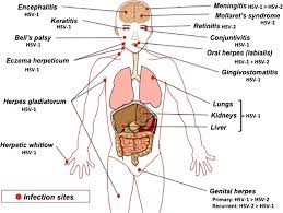 Condoms can help prevent the spread of herpes in some cases but. Clinical Manifestations Produced By Herpes Simplex Viruses The Sites Download Scientific Diagram