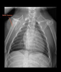 In the beginning the lameness is not continuous. When The Vet S Dog Has Cancer Part 1 Canada West Veterinary Specialists