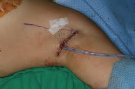 Published on september 29, 2014. Transaxillary Subpectoral Placement Of Cardiac Implantable Electronic Devices In Young Female Patients