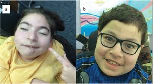 The clinical and genetic spectrum of autosomal-recessive TOR1A-related  disorders