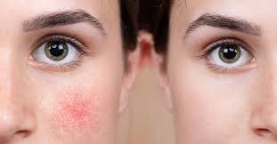 Rosacea causes red, irritated skin and pimples. Die Richtige Pflege Bei Rosacea Was Hilft Wirklich Dermasence