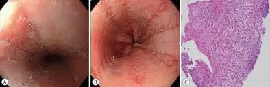 As the practice shows, hypodiagnostics of eosinophilic esophagitis and other eosinophilic gastrointestinal diseases takes place. Clinical Endoscopy