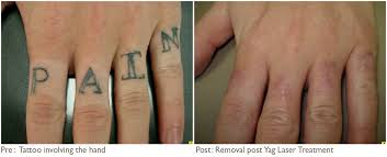 My first tattoo was done poorly and scarred really badly. Tattoo Removal Kootenay Medical Centre