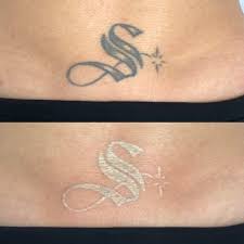 Laser tattoo removal works by targeting pigment colors in the skin's dermis, the layer of skin between the epidermis and subcutaneous tissues. Laser Tattoo Removal Vancouver Toronto Adrenaline Studios