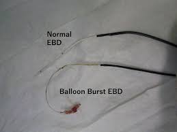On behalf of gateshead information network. Surgical Procedure For Unexpected Balloon Burst Complication During Endoscopic Balloon Dilatation In A Patient With Common Bile Duct Stones Surgical Case Reports Full Text