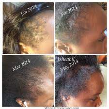 Pin By Junette Mirlande On J Shea Essential Oil Alopecia Hair Growth Relaxed Hair Muscle Relaxer