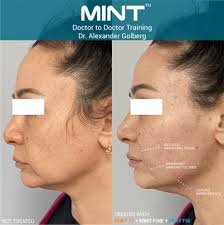 There are different kinds of threads which may be used to lift any part of the face, including the forehead, cheeks, jowls, jawline and neck. Pdo Thread Lift Nonsurgical Thread Mint Threads And String Lift