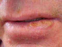 What does squamous cell cancer look like? Squamous Cell Carcinoma Of The Lip Images Dermnet Nz