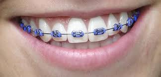 Blue Ligatures Jpg 600 289 Braces Teeth Colors Cute Braces Colors Dental Braces Colors