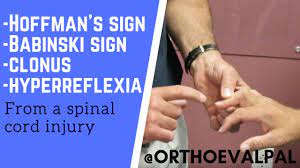 0 ratings0% found this document useful (0 votes). Positive Hoffman S Sign Positive Babinski Test Clonus Hyperreflexia In A C5 6 Injury Youtube