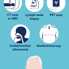 Sentinel node biopsy is a surgical procedure used to determine whether cancer has spread beyond a primary tumor into your lymphatic system. When Lung Cancer Spreads To Lymph Nodes