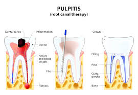 Image result for Pulpitis