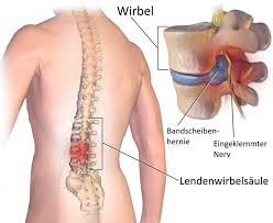 The herniated disc (red) presses on the yellow nerve.: Bandscheibenvorfall Die Beste Behandlung Healthcare In Europe Com