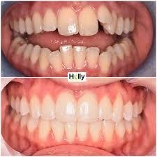 The invisalign system or braces can treat crossbites by moving the upper and lower teeth gradually into the correct bite position. 7 Dental Issues That Can Be Fixed With Invisalign Dentist Preston