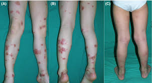We did not find results for: Methotrexate For Severe Nummular Eczema In Children Efficacy And Tolerability In A Retrospective Study Of 28 Patients Knopfel 2018 Pediatric Dermatology Wiley Online Library