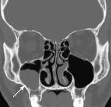 Image result for Maxillary Sinus