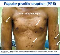 Image result for skin rash acute hiv infection