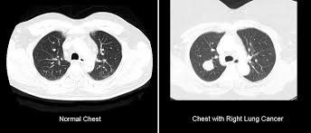 How to identify normal heart structures on a cardiac ct scan. A Case Study Using Deep Learning For The Early Detection Of Lung Cancer By Hrishikesh Murali Aits Journal Medium
