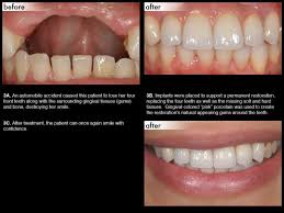 Dental Implants Sdny Dental