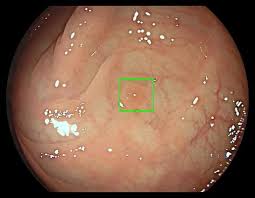 Kiran anna, md, discusses the incidence of colorectal cancer and the best screening methods. Fda Authorizes Marketing Of First Device That Uses Ai To Help Detect Potential Signs Of Colon Cancer Imaging Technology News