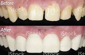 Porcelain Veneers In San Antonio Daniela Dental Daniela Dental