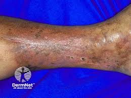 Image result for Lipodermatosclerosis