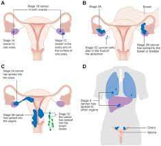 When this process begins, there may be no or only vague symptoms. Cancers Free Full Text Kinase Inhibitors And Ovarian Cancer Html