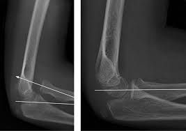 Image result for Radial Head Dislocation