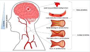 Pdf Cerebral Ischemic Stroke Cellular Fate And Therapeutic Opportunities Semantic Scholar