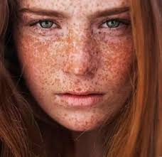 Why are freckles considered to be a beauty flaw?
