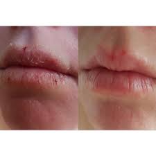 Windburn—you know, that moment when your face turns bright red, dry, and flaky after you've spent time outside in the cold and snow. Wind Burn Don T Let Your Jade S Beauty Retreat Facebook