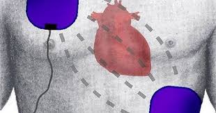 Automated External Defibrillators Market Global Industry Analysis And Forecast To 2025 How To Perform Cpr Cpr Automated External Defibrillators