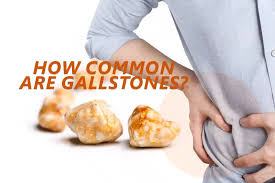 Image result for Gallstone
